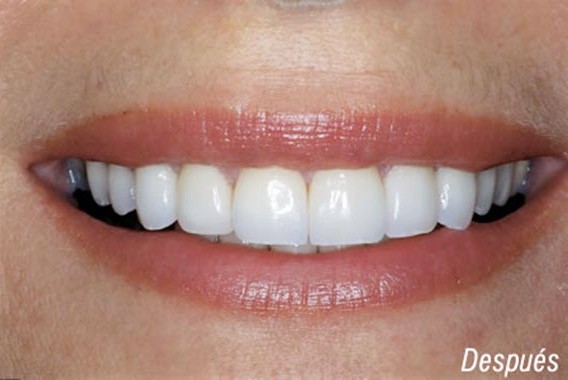 Resultado final del tratamiento dental